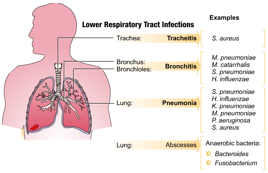 What are the most common symptoms of a lung infection?